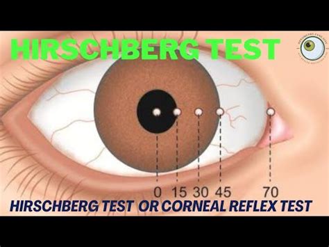 corneal reflex test results